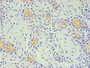 Immunohistochemical of paraffin-embedded Human breast cancer using CAC10268 (2E11-2B5) at dilution of 1:200.