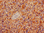 Immunohistochemistry of paraffin-embedded human glioma using CAC10269 at dilution of 1:100