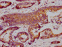 IHC image diluted at 1:100 and staining in paraffin-embedded human colon cancer performed on a Leica BondTM system. After dewaxing and hydration, antigen retrieval was mediated by high pressure in a citrate buffer (pH 6.0). Section was blocked with 10% normal goat serum 30min at RT. Then primary antibody (1% BSA) was incubated at 4°C overnight. The primary is detected by a biotinylated secondary antibody and visualized using an HRP conjugated SP system.