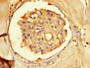 Immunohistochemistry of paraffin-embedded human breast cancer using CAC10351 at dilution of 1:100