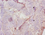Immunohistochemistry of paraffin-embedded human colon cancer using CAC10352 at dilution of 1:10