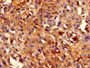 IHC image diluted at 1:800 and staining in paraffin-embedded human melanoma performed on a Leica BondTM system. After dewaxing and hydration, antigen retrieval was mediated by high pressure in a citrate buffer (pH 6.0). Section was blocked with 10% normal goat serum 30min at RT. Then primary antibody (1% BSA) was incubated at 4°C overnight. The primary is detected by a biotinylated secondary antibody and visualized using an HRP conjugated SP system.