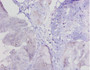 Immunohistochemistry of paraffin-embedded human colon cancer using CAC10376 at dilution of 1:20