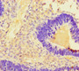 Immunohistochemistry of paraffin-embedded human ovarian cancer using CAC10388 at dilution of 1:100