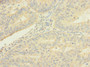 Immunohistochemistry of paraffin-embedded human endometrial cancer using CAC10390 at dilution of 1:100