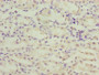 Immunohistochemistry of paraffin-embedded human gastric cancer using CAC10391 at dilution of 1:100