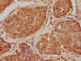 IHC image of CAC10406 diluted at 1:400 and staining in paraffin-embedded human liver cancer performed on a Leica BondTM system. After dewaxing and hydration, antigen retrieval was mediated by high pressure in a citrate buffer (pH 6.0). Section was blocked with 10% normal goat serum 30min at RT. Then primary antibody (1% BSA) was incubated at 4°C overnight. The primary is detected by a biotinylated secondary antibody and visualized using an HRP conjugated SP system.