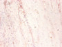 Immunohistochemistry of paraffin-embedded human colon cancer using CAC10418 at diluton of 1:50