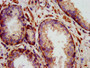 IHC image of CAC10443 diluted at 1:1400 and staining in paraffin-embedded human prostate cancer performed on a Leica BondTM system. After dewaxing and hydration, antigen retrieval was mediated by high pressure in a citrate buffer (pH 6.0). Section was blocked with 10% normal goat serum 30min at RT. Then primary antibody (1% BSA) was incubated at 4°C overnight. The primary is detected by a biotinylated secondary antibody and visualized using an HRP conjugated SP system. IHC image of CAC10443 diluted at 1:1400 and staining in paraffin-embedded human prostate cancer performed on a Leica BondTM system. After dewaxing and hydration, antigen retrieval was mediated by high pressure in a citrate buffer (pH 6.0). Section was blocked with 10% normal goat serum 30min at RT. Then primary antibody (1% BSA) was incubated at 4°C overnight. The primary is detected by a biotinylated secondary antibody and visualized using an HRP conjugated SP system.