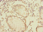 Immunohistochemistry of paraffin-embedded human colon cancer using CAC10449 at dilution of 1:100
