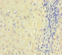 Immunohistochemistry of paraffin-embedded human liver cancer using CAC10450 at dilution of 1:100