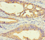 Immunohistochemistry of paraffin-embedded human colon cancer using CAC10464 at dilution of 1:100