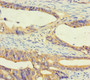 Immunohistochemistry of paraffin-embedded human colon cancer using CAC10472 at dilution of 1:100