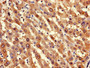 Immunohistochemistry of paraffin-embedded human liver cancer using CAC10491 at dilution of 1:100