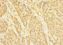 Immunohistochemistry of paraffin-embedded human ovarian cancer using CAC10494 at dilution of 1:100