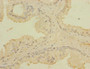 Immunohistochemistry of paraffin-embedded human prostata cancer using CAC10494 at dilution of 1:100