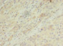 Immunohistochemistry of paraffin-embedded human liver cancer using CAC10500 at dilution of 1:100