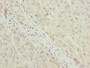 Immunohistochemistry of paraffin-embedded human liver cancer using CAC10503 at dilution of 1:100