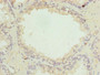 Immunohistochemistry of paraffin-embedded human prostate cancer using CAC10520 at dilution of 1:100