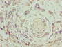 Immunohistochemistry of paraffin-embedded human pancreatic cancer using CAC10521 at dilution of 1:100 Immunohistochemistry of paraffin-embedded human pancreatic cancer using CAC10521 at dilution of 1:100