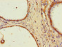 Immunohistochemistry of paraffin-embedded human prostate cancer using CAC10523 at dilution of 1:100