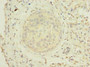 Immunohistochemistry of paraffin-embedded human cervical cancer using CAC10526 at dilution of 1:100