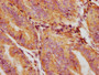 IHC image diluted at 1:132 and staining in paraffin-embedded human endometrial cancer performed on a Leica BondTM system. After dewaxing and hydration, antigen retrieval was mediated by high pressure in a citrate buffer (pH 6.0). Section was blocked with 10% normal goat serum 30min at RT. Then primary antibody (1% BSA) was incubated at 4°C overnight. The primary is detected by a biotinylated secondary antibody and visualized using an HRP conjugated SP system.