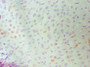 Immunohistochemistry of paraffin-embedded human cervical cancer using CAC10567 at dilution of 1:100