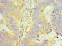 Immunohistochemistry of paraffin-embedded human colon cancer using CAC10595 at dilution of 1:100