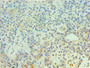 Immunohistochemistry of paraffin-embedded human breast cancer using CAC10599 at dilution of 1:100 Immunohistochemistry of paraffin-embedded human breast cancer using CAC10599 at dilution of 1:100