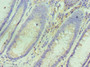 Immunohistochemistry of paraffin-embedded human colon cancer using CAC10605 at dilution of 1:100