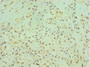 Immunohistochemistry of paraffin-embedded human breast cancer using CAC10607 at dilution of 1:100