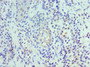 Immunohistochemistry of paraffin-embedded human breast cancer using CAC10617 at dilution of 1:100 Immunohistochemistry of paraffin-embedded human breast cancer using CAC10617 at dilution of 1:100