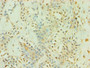 Immunohistochemistry of paraffin-embedded human breast cancer using CAC10623 at dilution of 1:100
