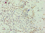 Immunohistochemistry of paraffin-embedded human breast cancer using CAC10646 at dilution of 1:100