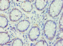 Immunohistochemistry of paraffin-embedded human colon cancer using CAC10646 at dilution of 1:100