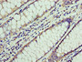 Immunohistochemistry of paraffin-embedded human colon cancer using CAC10663 at dilution of 1:100