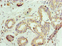 Immunohistochemistry of paraffin-embedded human breast cancer using CAC10663 at dilution of 1:100