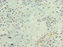 Immunohistochemistry of paraffin-embedded human breast cancer using CAC10667 at dilution of 1:100