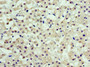 Immunohistochemistry of paraffin-embedded human liver cancer using CAC10669 at dilution of 1:100