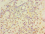 Immunohistochemistry of paraffin-embedded human breast cancer using CAC10671 at dilution of 1:100