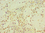 Immunohistochemistry of paraffin-embedded human breast cancer using CAC10678 at dilution of 1:100 Immunohistochemistry of paraffin-embedded human breast cancer using CAC10678 at dilution of 1:100