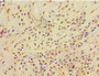 Immunohistochemistry of paraffin-embedded human breast cancer using CAC10683 at dilution of 1:100