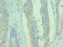 Immunohistochemistry of paraffin-embedded human colon cancer using CAC10691 at dilution of 1:100