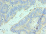 Immunohistochemistry of paraffin-embedded human colon cancer using CAC10696 at dilution of 1:100