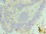 Immunohistochemistry of paraffin-embedded human colon cancer using CAC10698 at dilution of 1:100