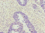 Immunohistochemistry of paraffin-embedded human ovarian cancer using CAC10704 at dilution of 1:100