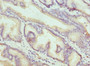 Immunohistochemistry of paraffin-embedded human prostate cancer using CAC10710 at dilution of 1:100