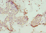 Immunohistochemistry of paraffin-embedded human breast cancer using CAC10712 at dilution of 1:100