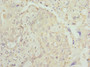 Immunohistochemistry of paraffin-embedded human lung cancer using CAC10718 at dilution of 1:100